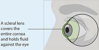 Kirkwood Eye Associates specializes in Scleral Contact Lenses