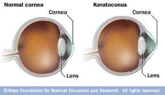 Kirkwood Eye Associates specializes in treating Keratoconus