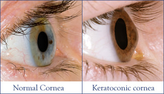 Normal cornea vs Keratoconic cornea